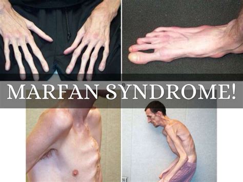 syndrome de marfan -- photo|morphans disease.